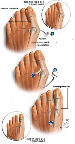 Bunionectomy. Suche nach einem Gipsverband. Bunionectomy. Suche nach einem Gipsverband.