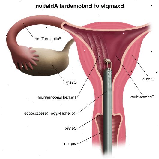 Endometriumablation. nach andndash; in Krankenhaus. Endometriumablation. nach andndash; in Krankenhaus.