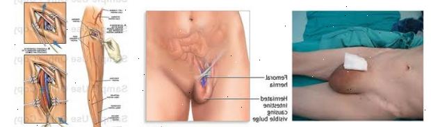 Femoralis embolectomy. nach andndash; in Krankenhaus. Femoralis embolectomy. nach andndash; in Krankenhaus.