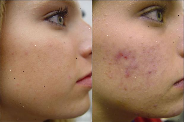 Acne. was sind die Symptome? Acne. was sind die Symptome?