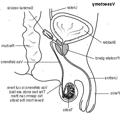 Vasektomie (Sterilisation für Männer). wer kann eine Vasektomie? Vasektomie (Sterilisation für Männer). wer kann eine Vasektomie?