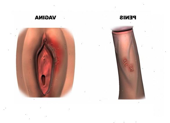 Genital-Herpes. Was ist Herpes genitalis? Genital-Herpes. Was ist Herpes genitalis?