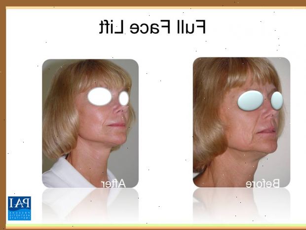 Volle Facelifting. nach andndash; in Krankenhaus. Volle Facelifting. nach andndash; in Krankenhaus.
