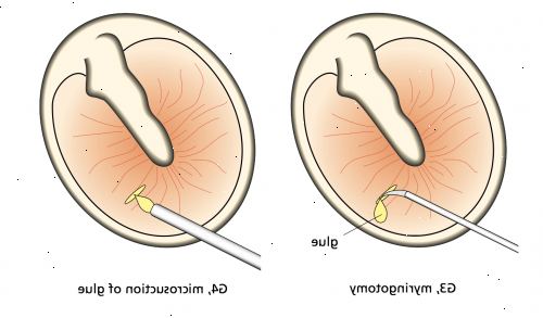 Tülle Insertion. nach andndash; in Krankenhaus. Tülle Insertion. nach andndash; in Krankenhaus.