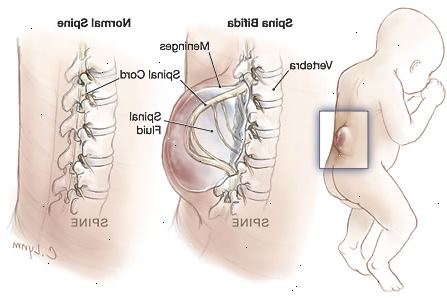 Spina bifida. was bewirkt, Spina bifida? Spina bifida. was bewirkt, Spina bifida?