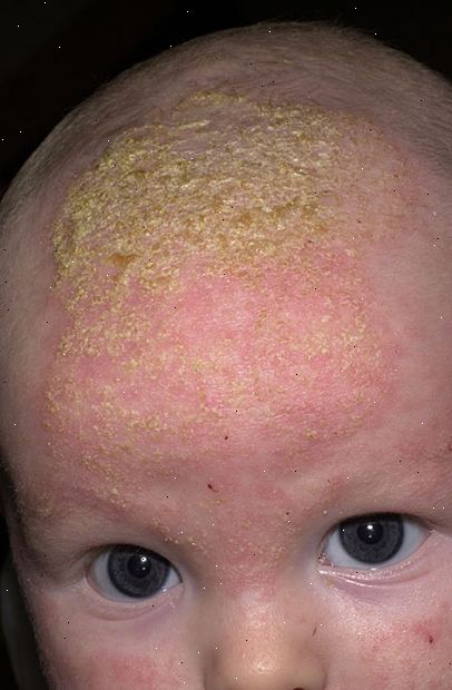 Milchschorf (infantile seborrhoische Dermatitis). was sind die Symptome? Milchschorf (infantile seborrhoische Dermatitis). was sind die Symptome?