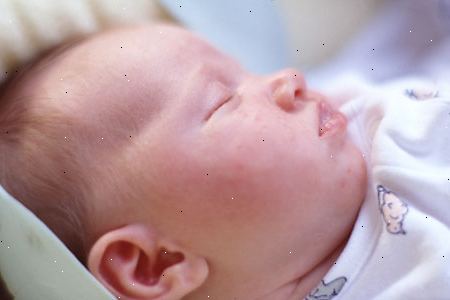 Infantile Ekzem. was ist infantile Ekzem? Infantile Ekzem. was ist infantile Ekzem?