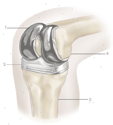 Kniegelenkersatz. nach andndash; in Krankenhaus. Kniegelenkersatz. nach andndash; in Krankenhaus.