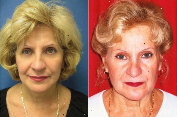 Senken Facelifting. nach andndash; in Krankenhaus. Senken Facelifting. nach andndash; in Krankenhaus.
