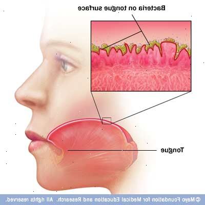 Mundgeruch (Halitosis). was verursacht schlechten Atem? Mundgeruch (Halitosis). was verursacht schlechten Atem?
