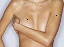 Knoten in der Brust