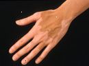 Pigmentierung und Vitiligo