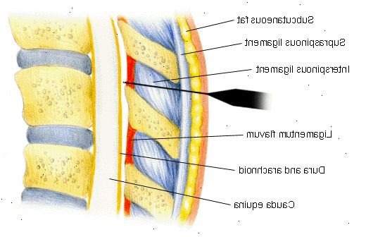 Epiduralanästhesie. ein Abfall des Blutdrucks. Epiduralanästhesie. ein Abfall des Blutdrucks.