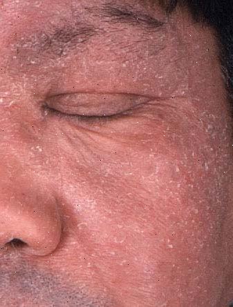 Chronische aktinische Dermatitis. Was ist eine chronische aktinische Dermatitis? Chronische aktinische Dermatitis. Was ist eine chronische aktinische Dermatitis?