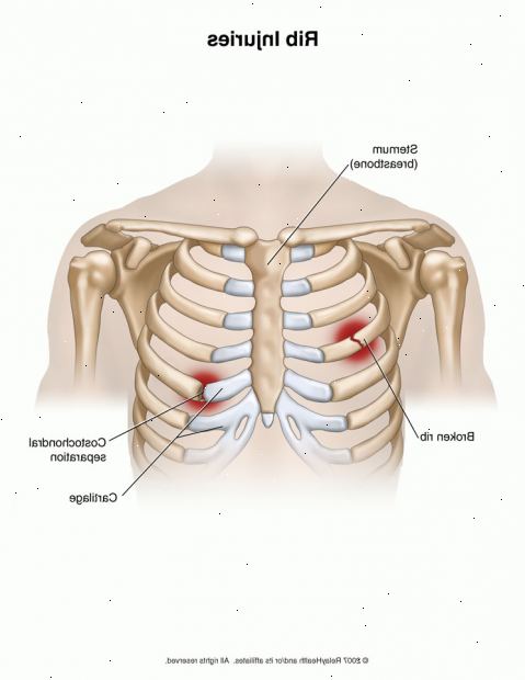 Costochondritis (Tietze-Syndrom). was ist Costochondritis? Costochondritis (Tietze-Syndrom). was ist Costochondritis?