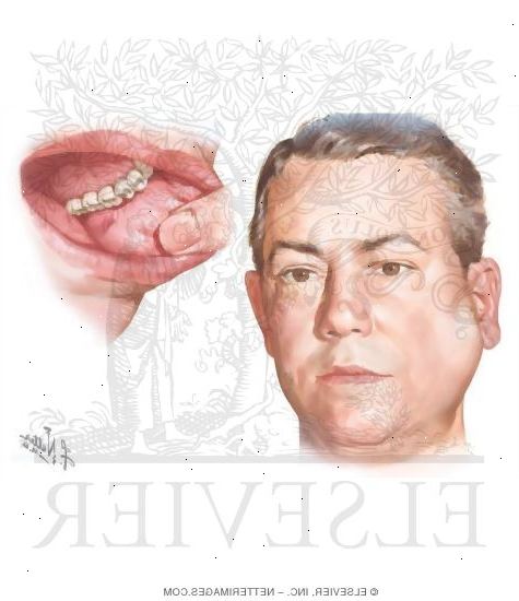 Mumps. was sind die Ohrspeicheldrüse? Mumps. was sind die Ohrspeicheldrüse?