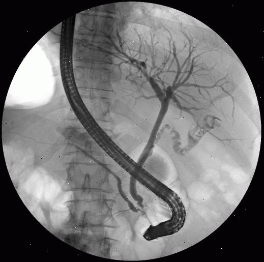 ERCP. wie wird ERCP durchgeführt? ERCP. wie wird ERCP durchgeführt?