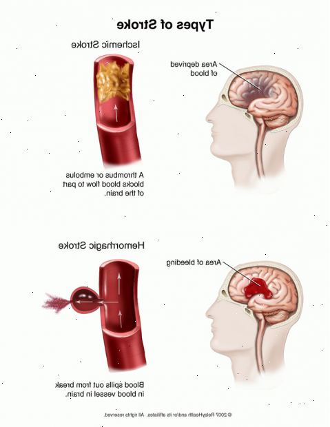 Stroke (Schlaganfall). transitorische ischämische Attacke (TIA). Stroke (Schlaganfall). transitorische ischämische Attacke (TIA).