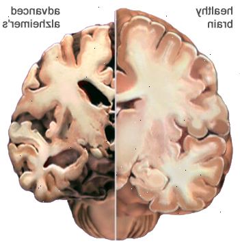Alzheimer-Krankheit. was ist die Alzheimer-Krankheit? Alzheimer-Krankheit. was ist die Alzheimer-Krankheit?