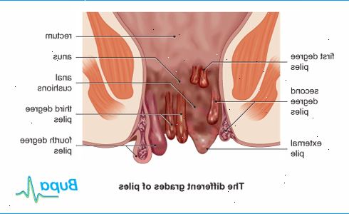 Hämorrhoiden (Hämorrhoiden). Was sind Hämorrhoiden? Hämorrhoiden (Hämorrhoiden). Was sind Hämorrhoiden?
