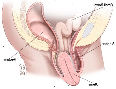 Gebärmuttervorfall. was ist Uterusprolaps? Gebärmuttervorfall. was ist Uterusprolaps?