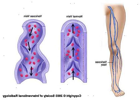 Krampfadern. was ist der Unterschied zwischen Venen und Arterien? Krampfadern. was ist der Unterschied zwischen Venen und Arterien?