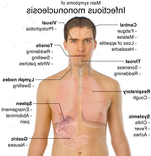 Drüsenfieber (infektiöse Mononukleose). was ist Drüsenfieber? Drüsenfieber (infektiöse Mononukleose). was ist Drüsenfieber?