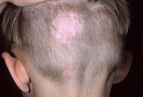 Ringworm der Kopfhaut (Tinea capitis). was ist ringworm der Kopfhaut? Ringworm der Kopfhaut (Tinea capitis). was ist ringworm der Kopfhaut?