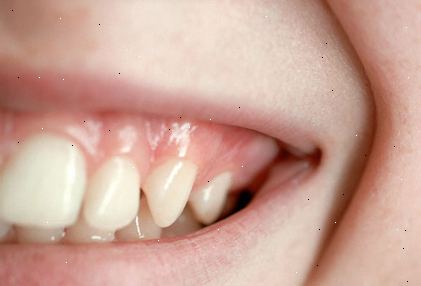Wie gesund sind Ihre Zähne? Zahnfleischerkrankungen: die hässliche Wahrheit. Wie gesund sind Ihre Zähne? Zahnfleischerkrankungen: die hässliche Wahrheit.