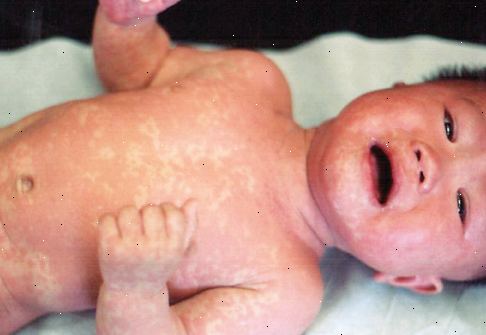 Drei-Tage-Fieber (roseola infantum). was ist dreitägigen Fieber? Drei-Tage-Fieber (roseola infantum). was ist dreitägigen Fieber?