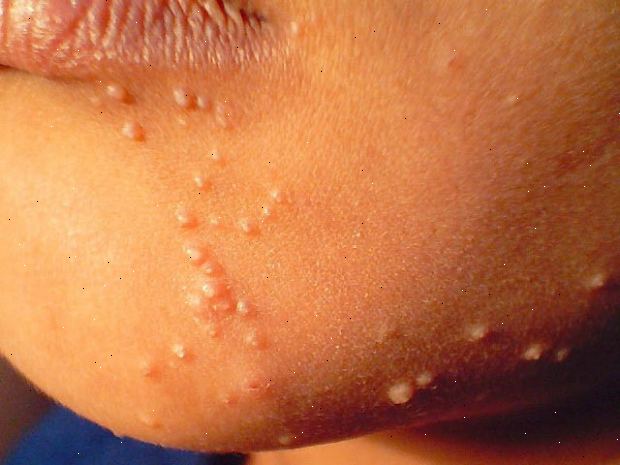 Molluscum contagiosum. was ist Dellwarzen? Molluscum contagiosum. was ist Dellwarzen?
